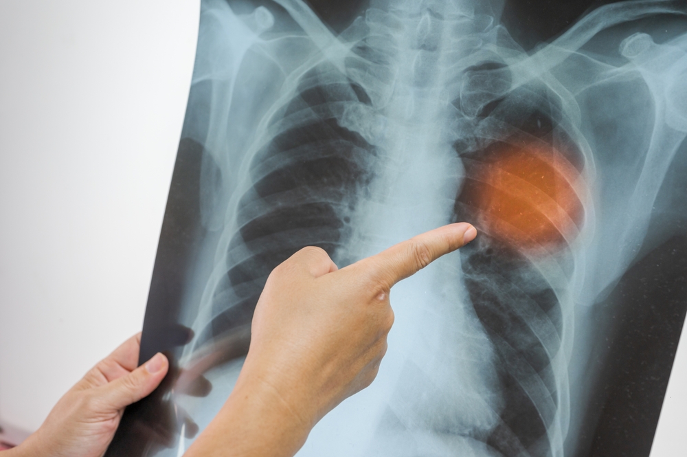 Broken Rib Injury in Pennsylvania