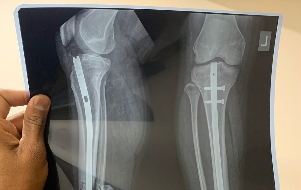 Average Settlements in Knee Replacement Recall