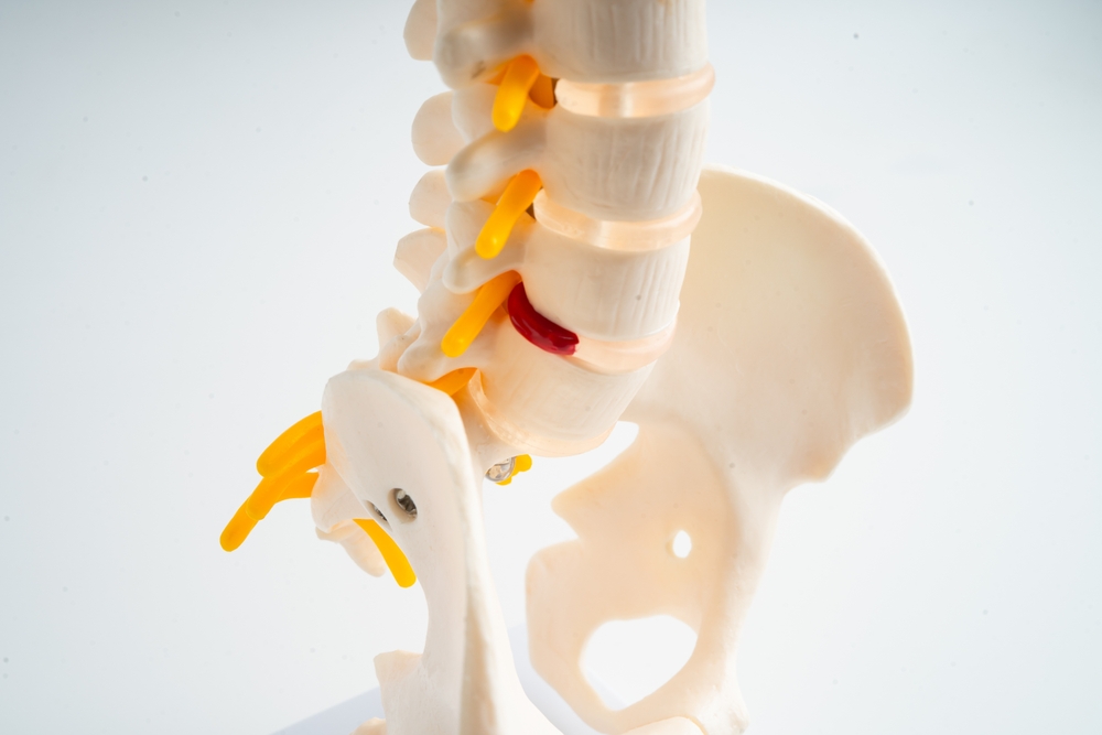 Signs You May Have A Herniated Disc After A Fall