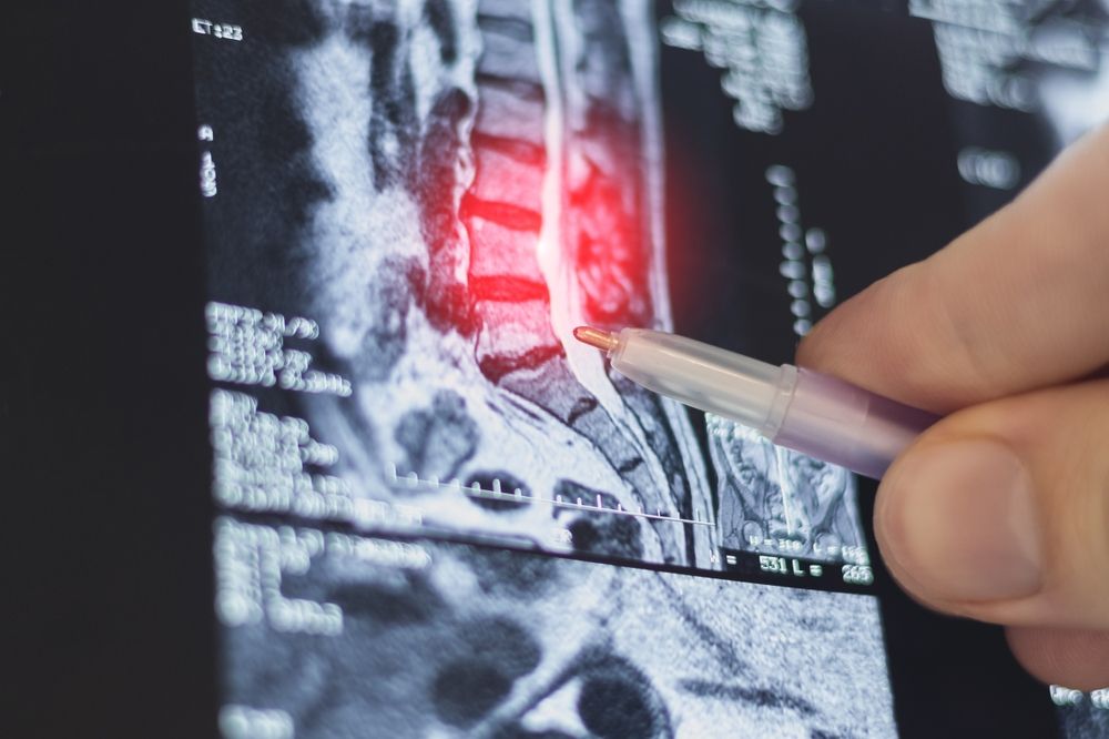 How Spine Surgery Impacts A Slip And Fall Injury Claim