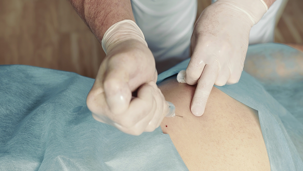 Average Settlement for Three Epidural Injections Back injury victim receiving epidural steroid injections after a car accident